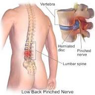 disc-herniation-back-pain