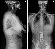 Chiropractor reviewing spinal X-rays during Gonstead evaluation