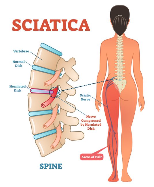 Person experiencing radiating leg pain from lower back due to sciatica
